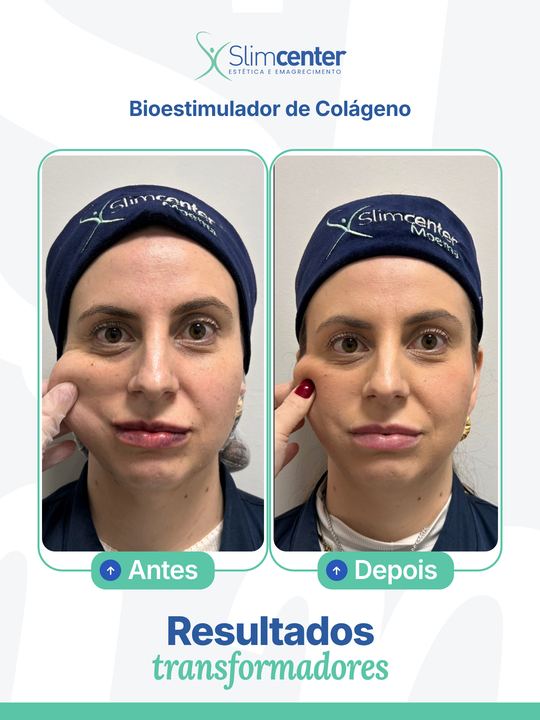 Antes e depois de Bioestimulador de Colágeno