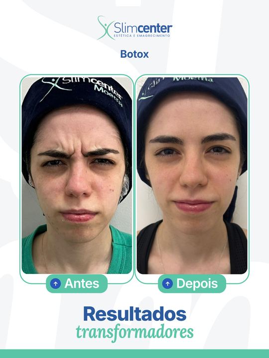 Antes e depois de Toxina Botulínica