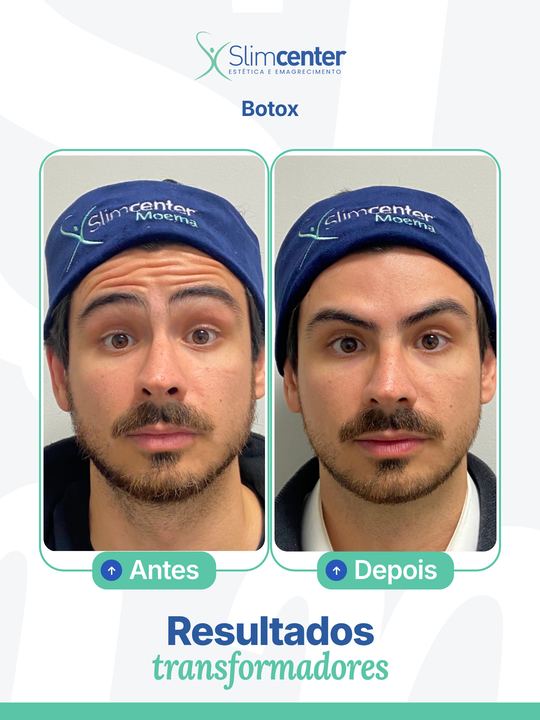 Antes e depois de Toxina Botulínica