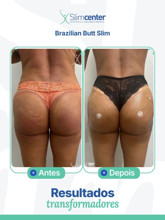 Antes e depois de Brazilian Butt Slim