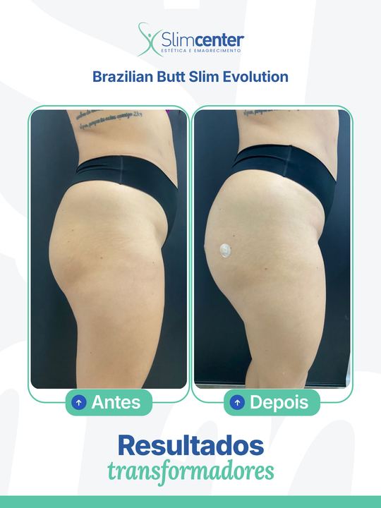 Antes e depois de Brazilian Butt Slim Evolution