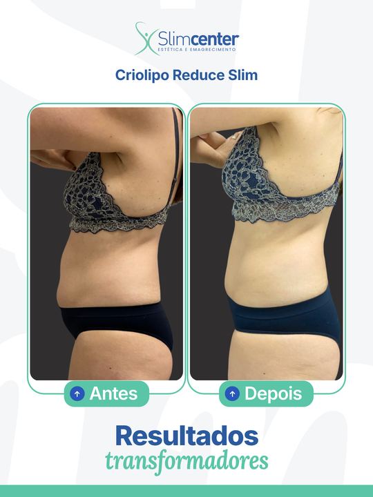 Antes e depois de Criolipo Reduce Slim