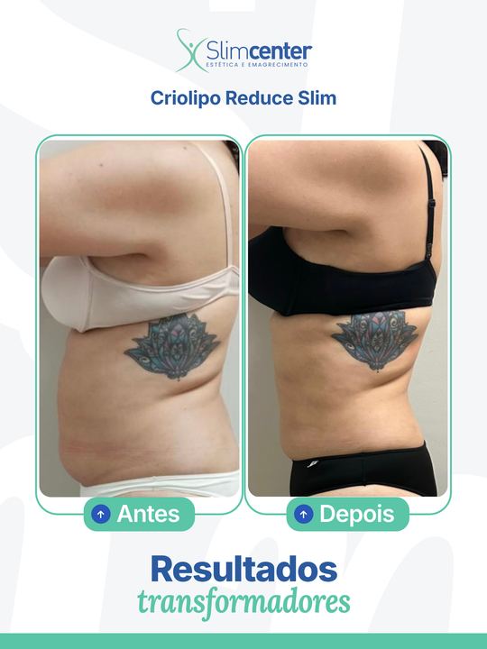 Antes e depois de Criolipo Reduce Slim