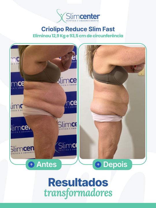 Antes e depois de Criolipo Reduce Slim
