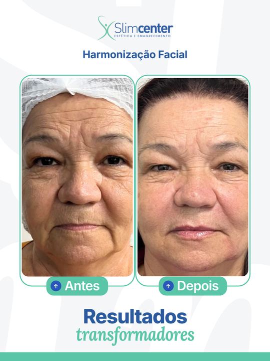 Antes e depois de Preenchimento Facial