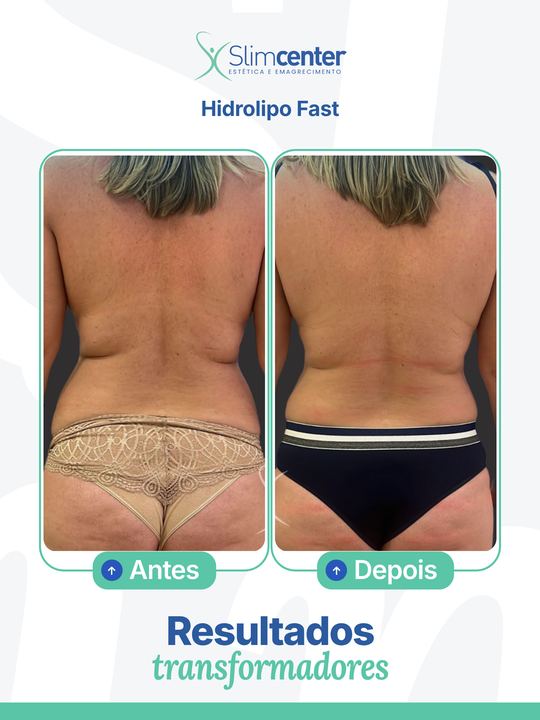 Antes e depois de Hidrolipo Reduce Slim