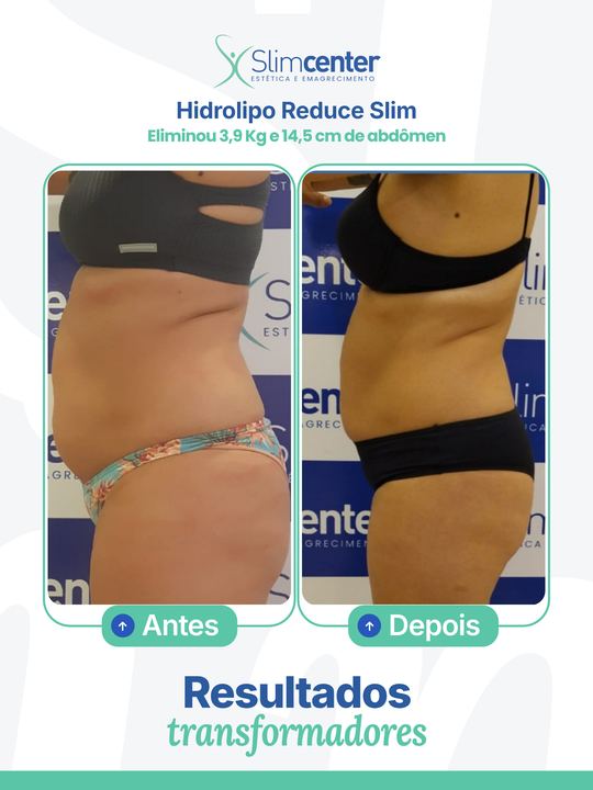 Antes e depois de Hidrolipo Reduce Slim