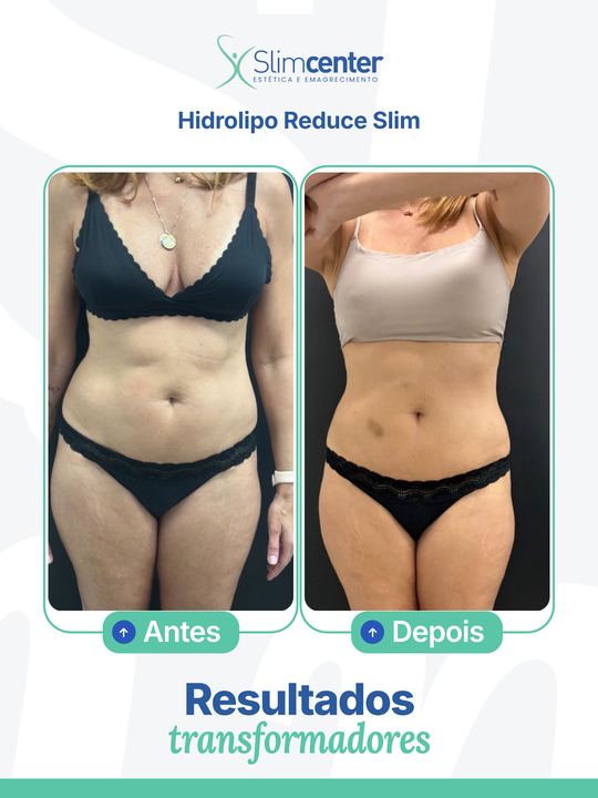 Antes e depois de Hidrolipo Reduce Slim