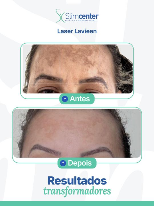 Antes e depois de Lavieen