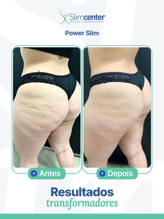 Antes e depois de Power Slim Turbo