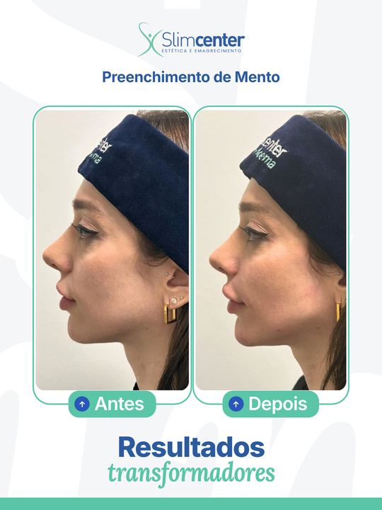 Antes e depois de Preenchimento Facial