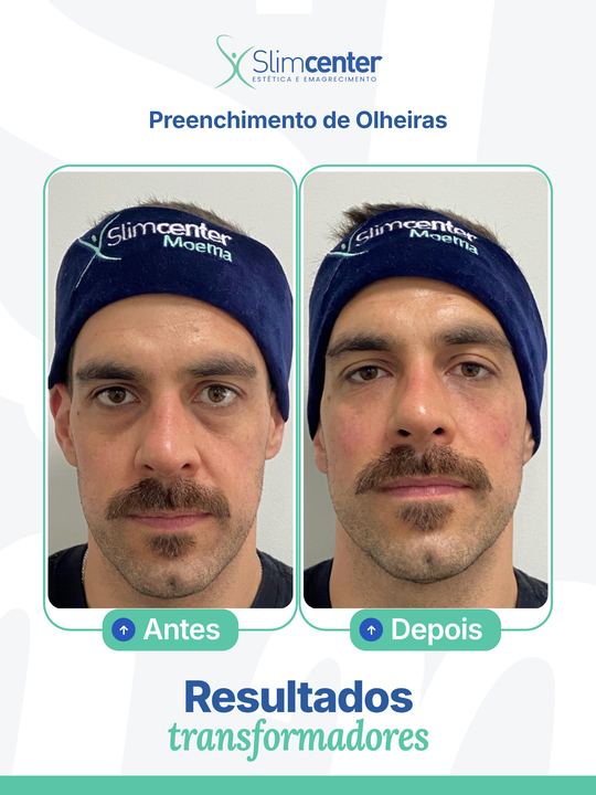 Antes e depois de Preenchimento de Olheiras