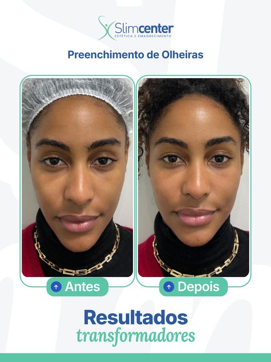 Antes e depois de Preenchimento de Olheiras