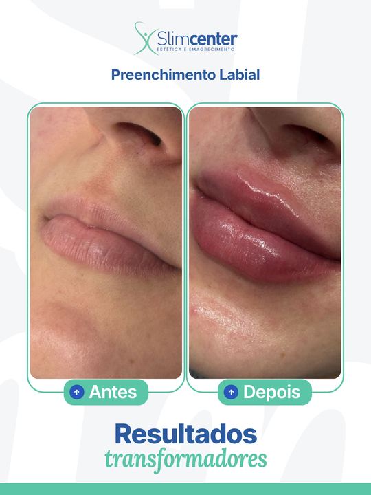 Antes e depois de Preenchimento Labial
