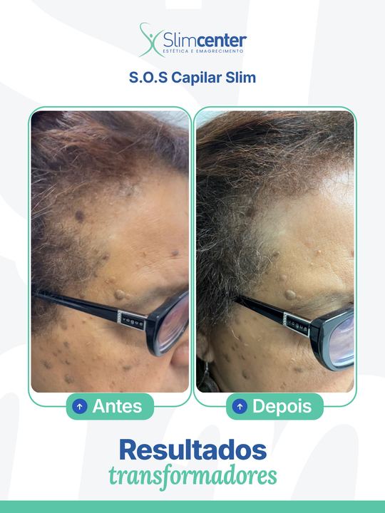 Antes e depois de S.O.S Capilar Slim