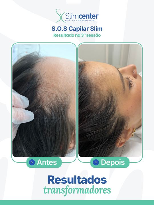 Antes e depois de S.O.S Capilar Slim