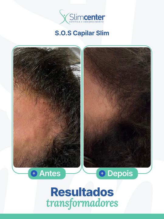 Antes e depois de S.O.S Capilar Slim