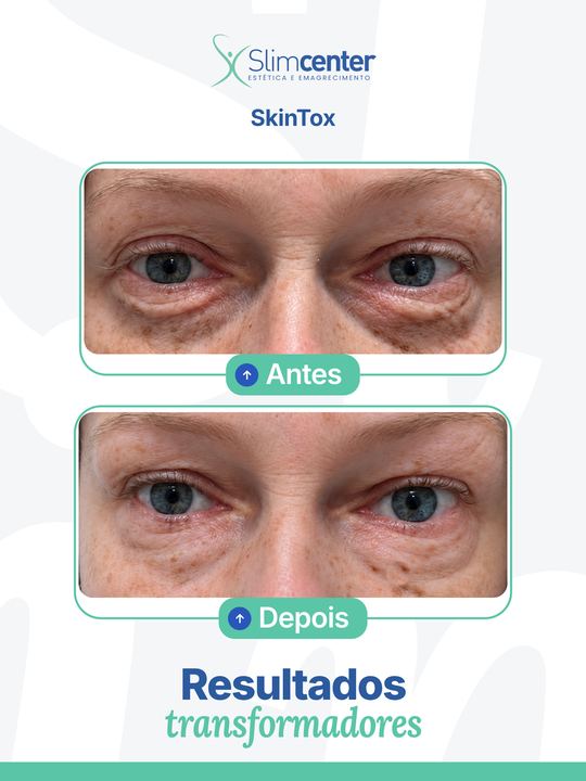 Antes e depois de SkinTox Slim®