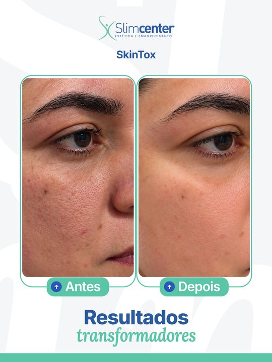 Antes e depois de SkinTox Slim®