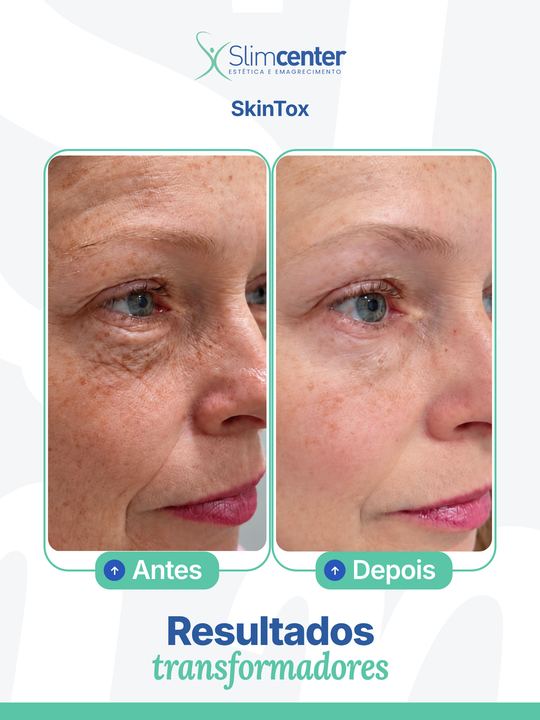 Antes e depois de SkinTox Slim®