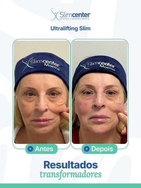 Antes e depois de Ultralifting Slim